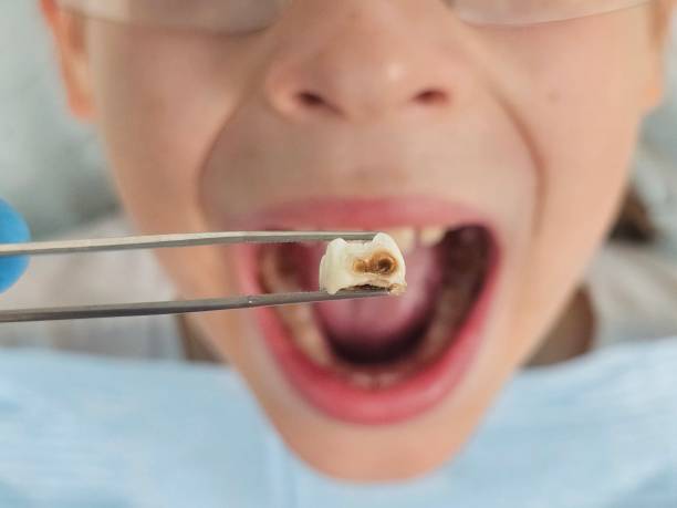 Best Emergency Tooth Extraction in Rock Hill, NY